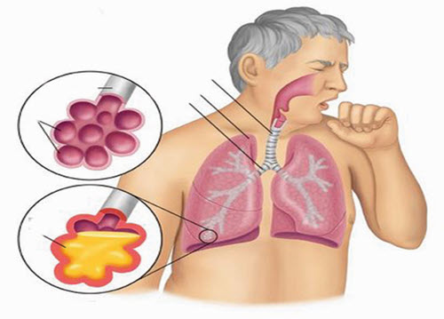 پنوموني باكتريال